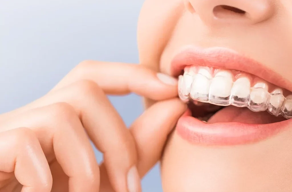 Alineadores invisibles Invisalign