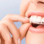 Alineadores invisibles Invisalign