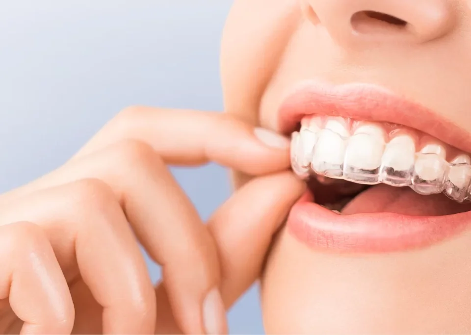 Alineadores invisibles Invisalign